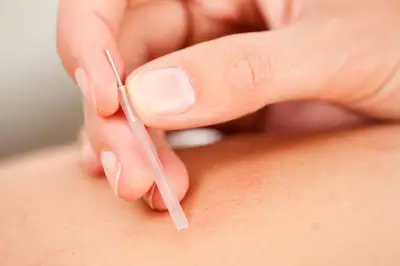 Acupunctuur verlicht klachten bij kanker