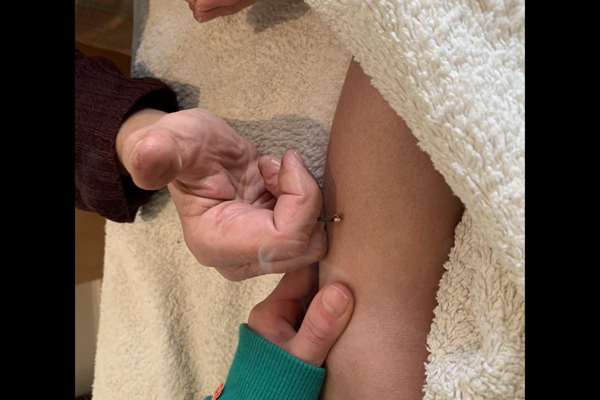 Acupunctuur behandeling Beneden-Leeuwen – Praktijk de Libelle