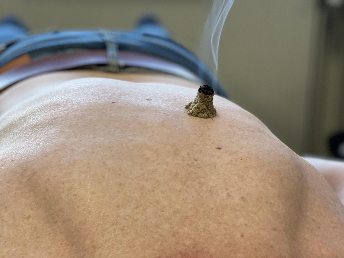 Acupunctuur behandeling Beneden-Leeuwen – Praktijk de Libelle